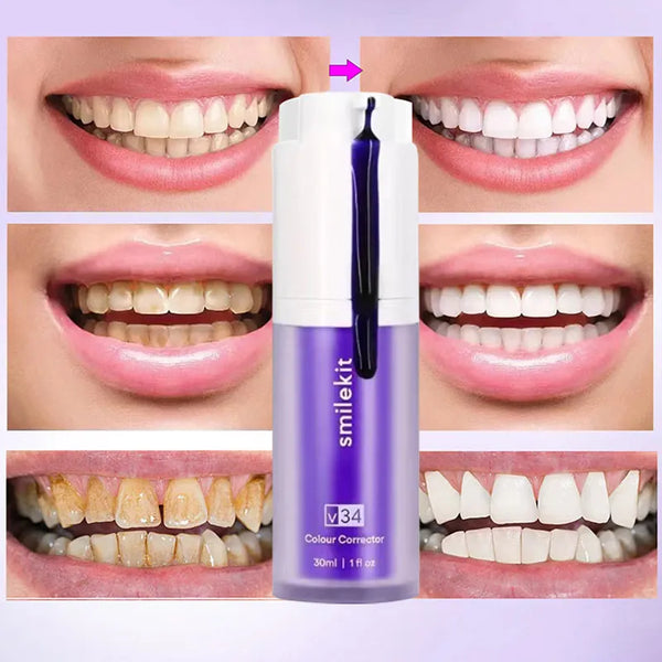 SmileBrite™ - Teeth Whitening Kit