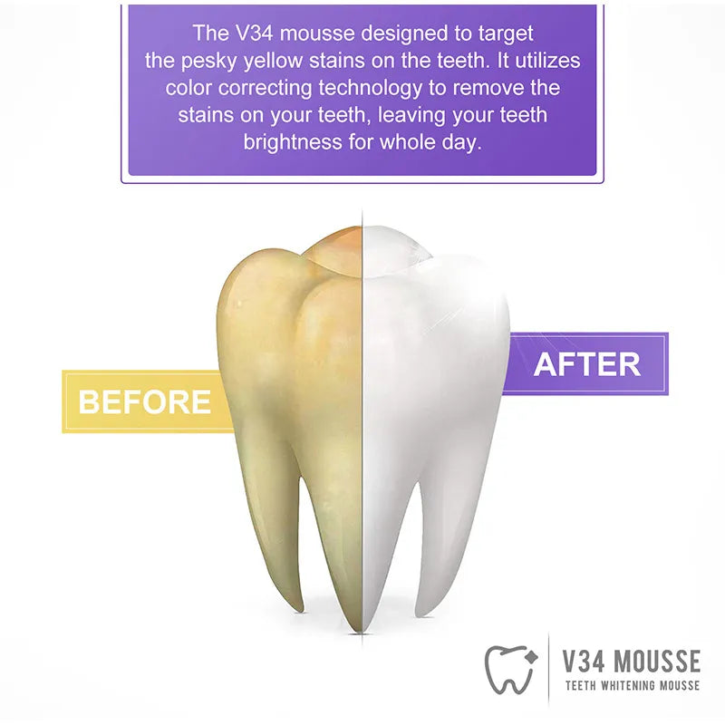 SmileBrite™ - Teeth Whitening Kit