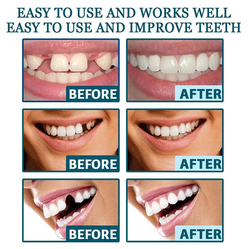 NewSmile™ - Snap-On Dentures
