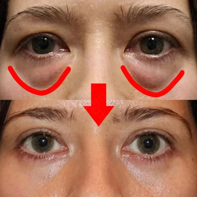 RadiantEyes™ - Eye Bags Removal Patch