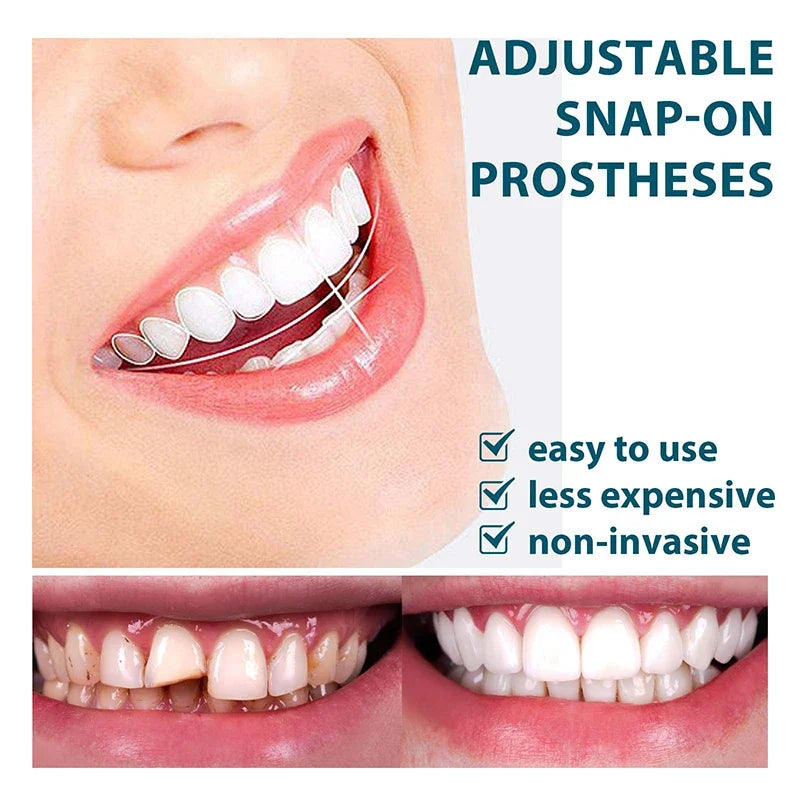 NewSmile™ - Snap-On Dentures