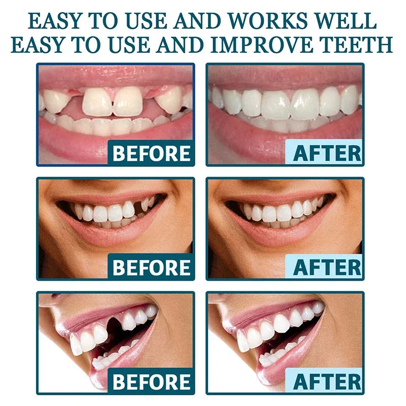 NewSmile™ - Snap-On Dentures