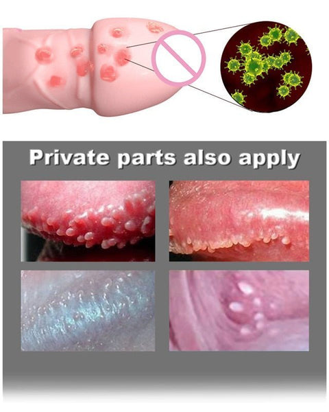 AntiWart™ - Painless Warts Solution - TumTum