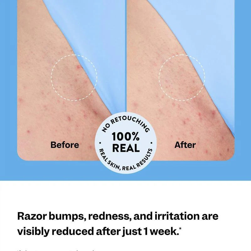 Relivra ™ - Ingrown Hair Treatment