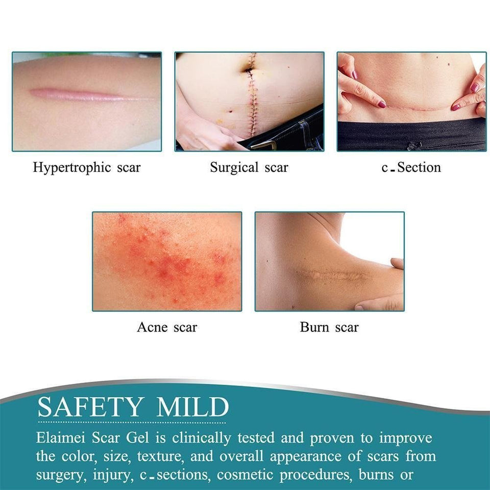 ELAIMEI™ Medical Soft Silicone Gel Tape for Scar Removal (1.6” x 60”） - TumTum