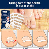 NailFixer™ - Toenail Paronychia Corrector (50 Pcs ) - TumTum