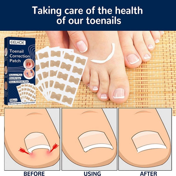 NailFixer™ - Toenail Paronychia Corrector (50 Pcs ) - TumTum