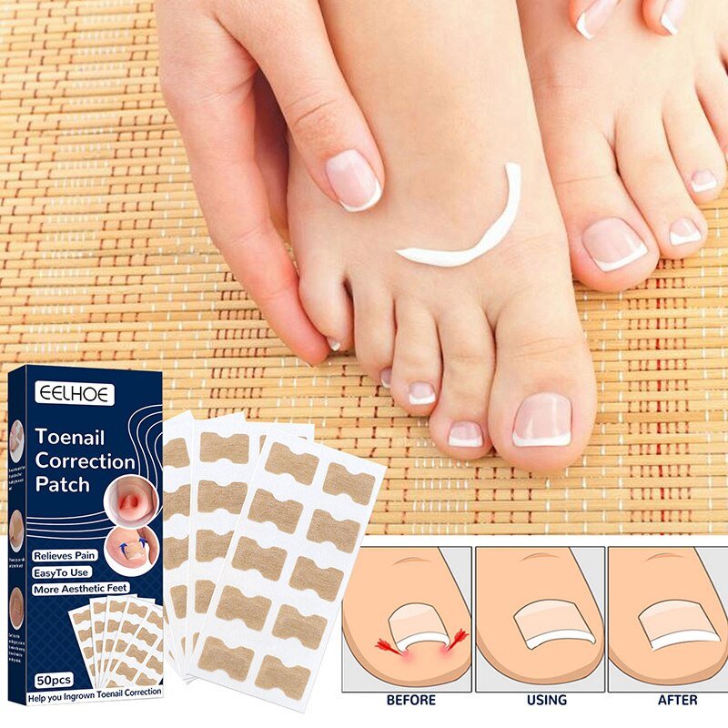 NailFixer™ - Toenail Paronychia Corrector (50 Pcs ) - TumTum
