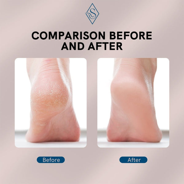 Rechargeable Electric Foot Callus Remover Pedicure Machine - TumTum