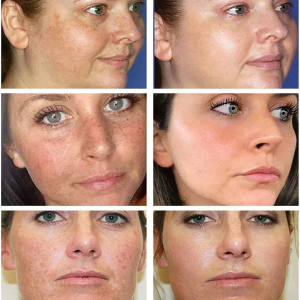 TumTum ™ - Dark Spot Corrector Remover - TumTum