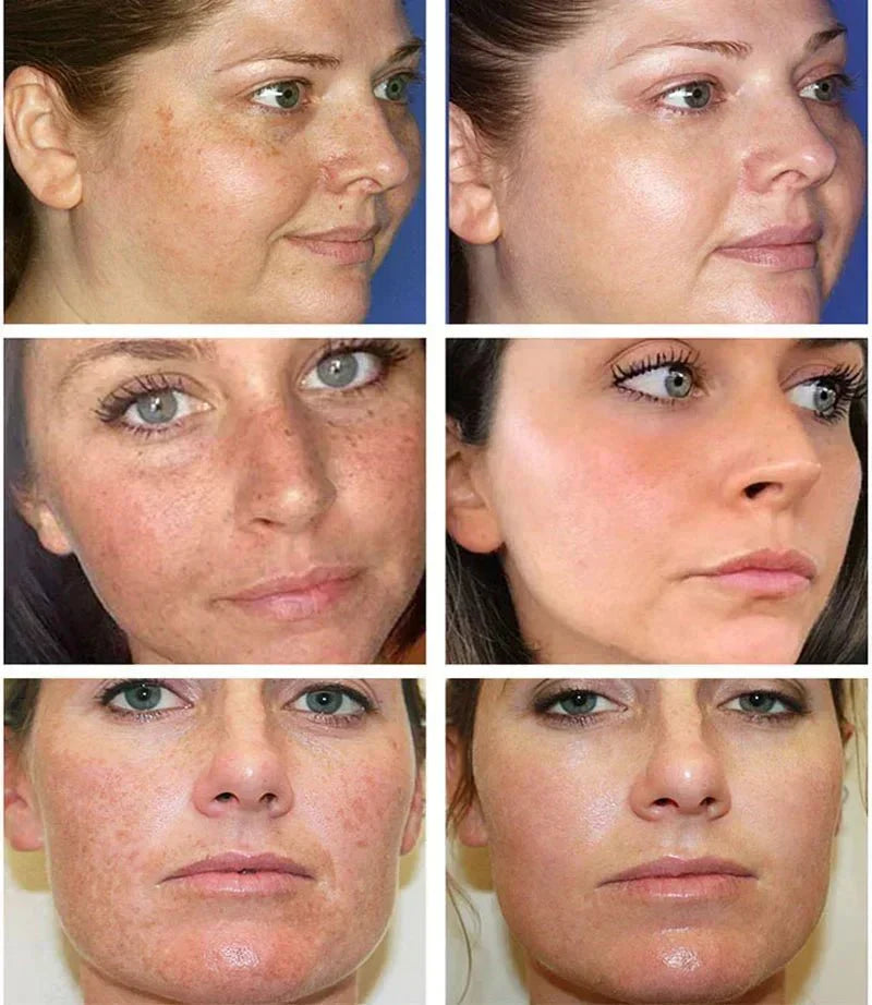 TumTum ™ - Dark Spot Corrector Remover - TumTum